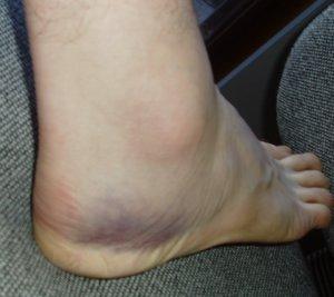 Outside of foot (this is the sore side)